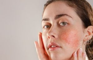 9 Cara Alami Menghilangkan Kemerahan di Wajah yang Efektif