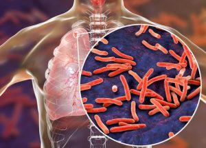 9 Cara Mendiagnosis TBC, Kenali Tahapannya