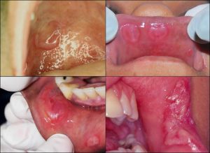 Infeksi mulut serta gigi
